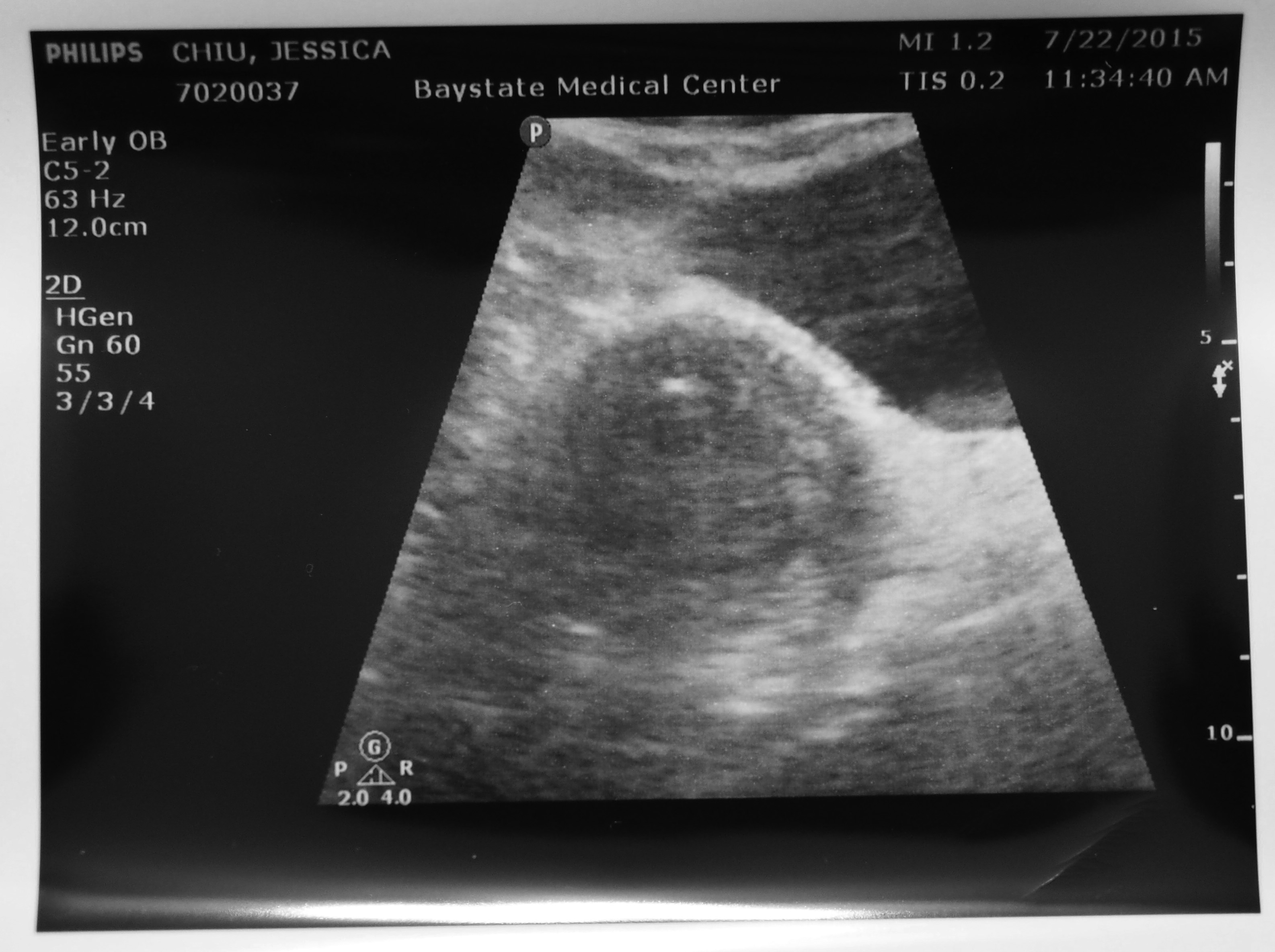transfer ultrasound