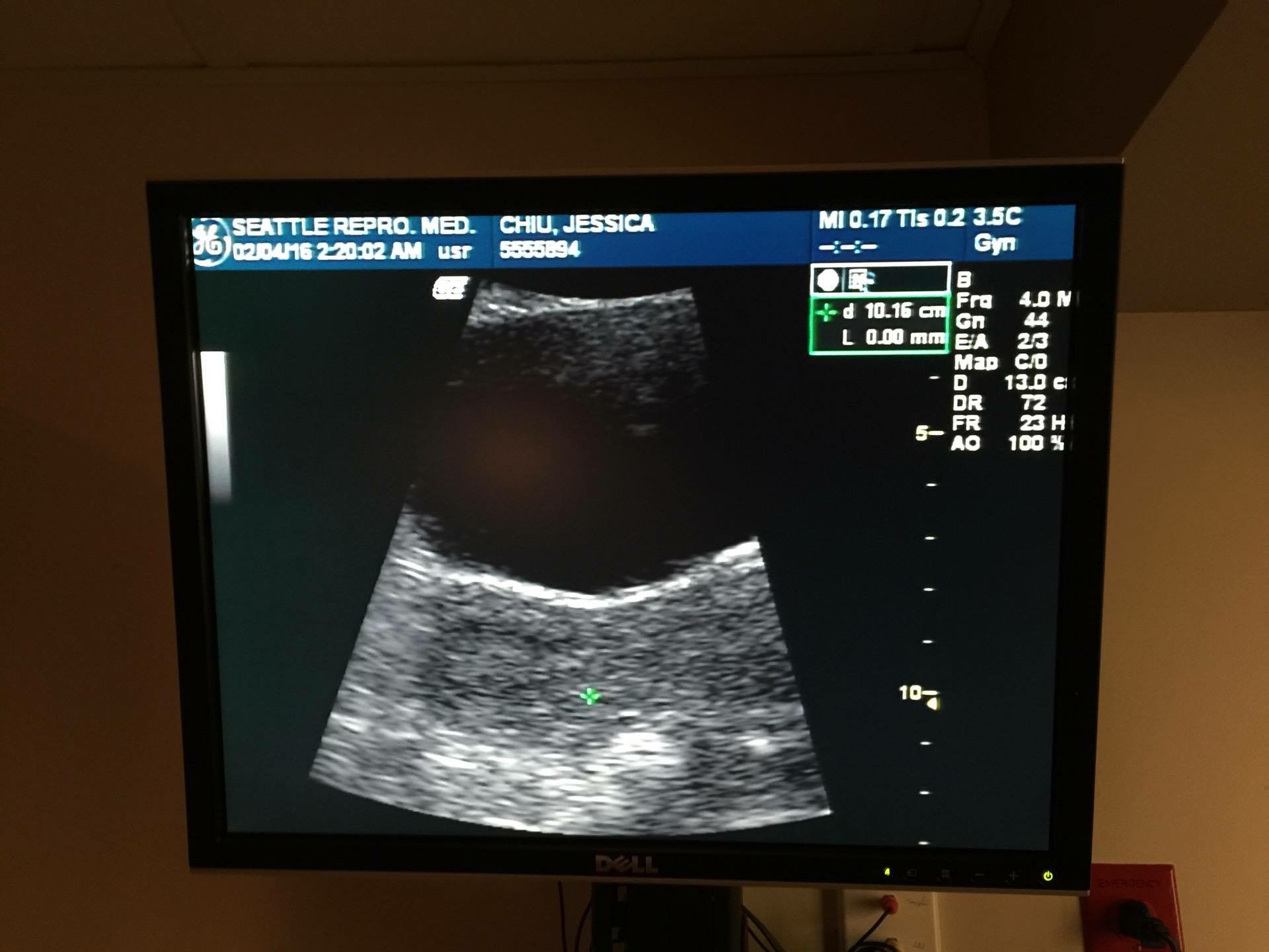 Embryo Transfer Ultrasound